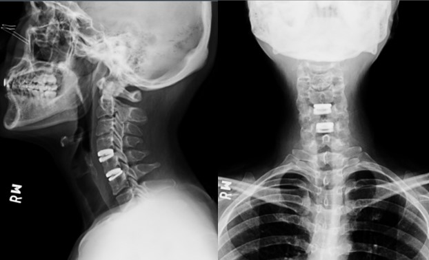 頸椎人工椎間盤置換示意圖