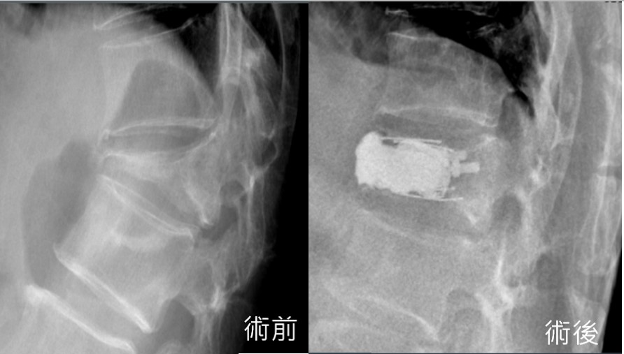 椎體壓迫性骨折示意圖