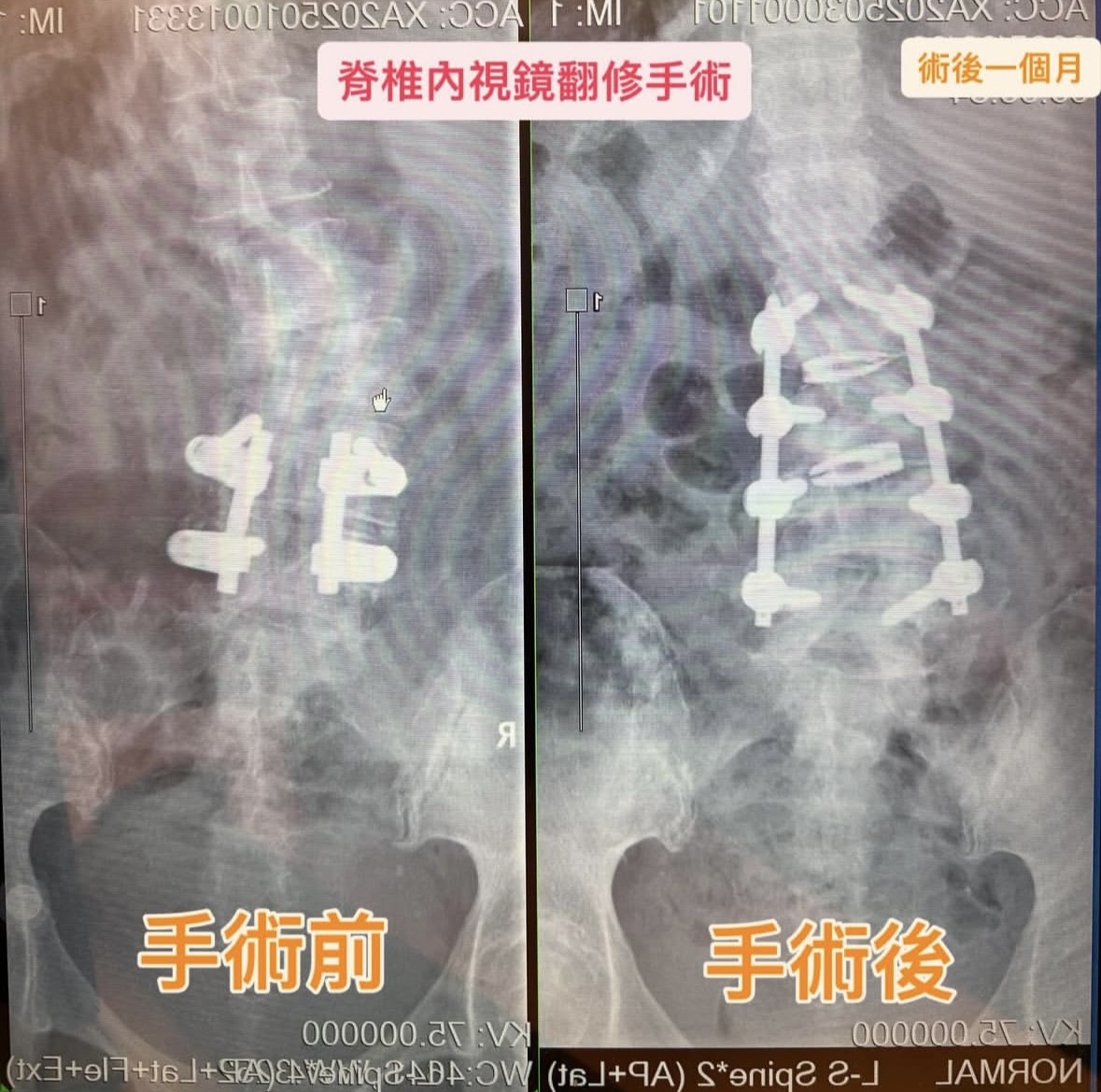 退化性側彎示意圖