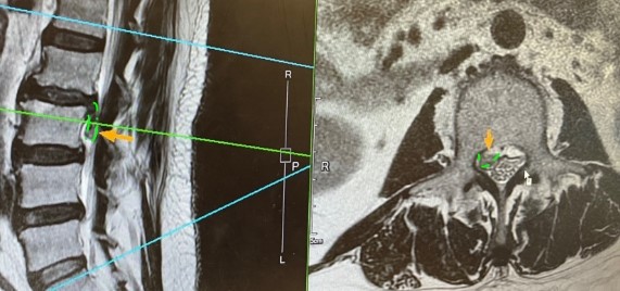 椎間盤突出壓迫神經示意圖