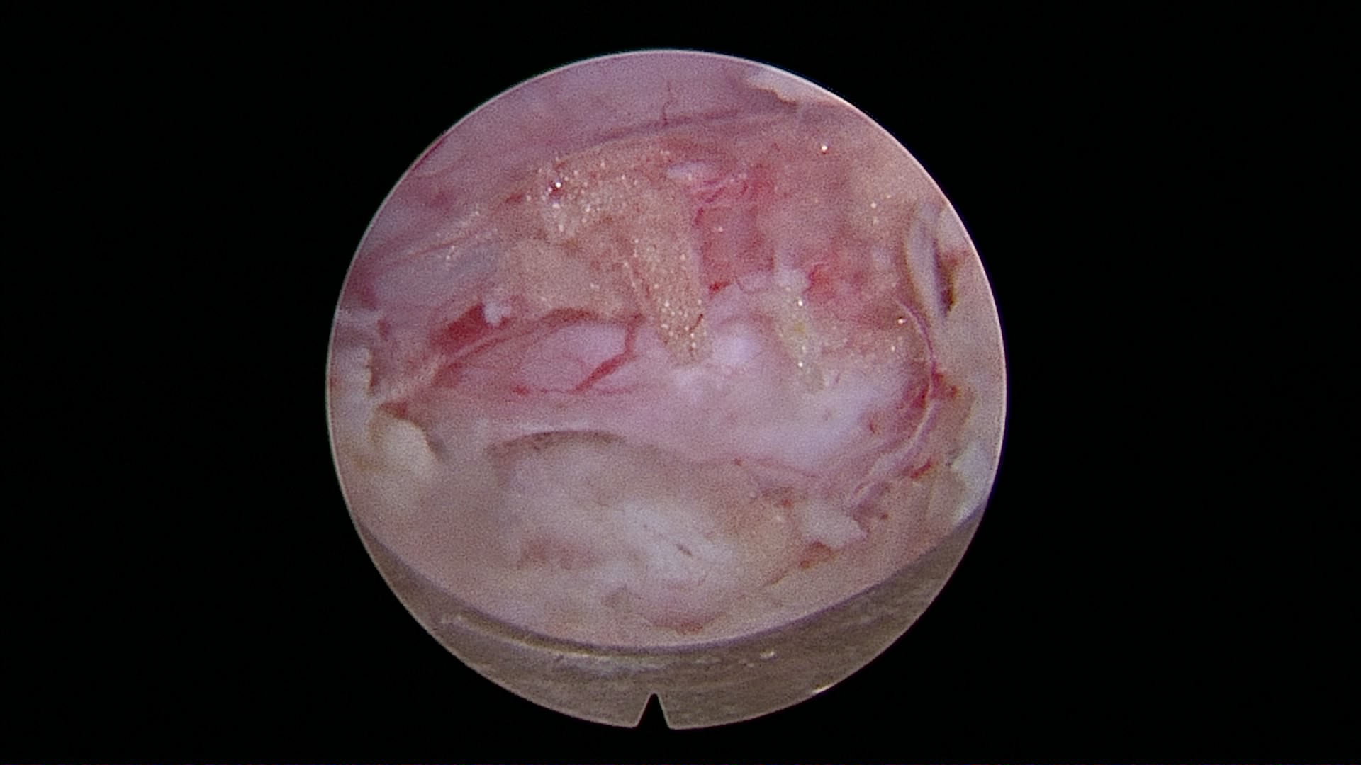 脊椎內視鏡手術示意圖