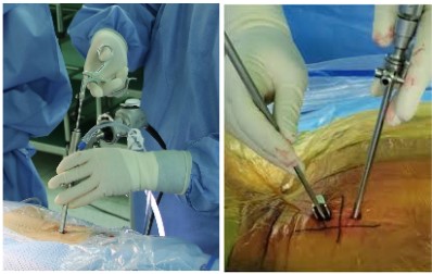 單通道與雙通道內視鏡比較示意圖