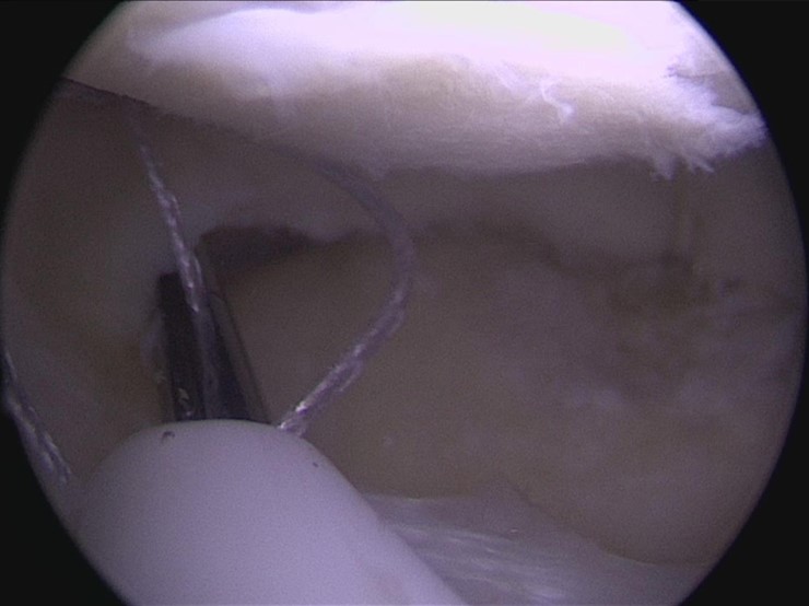 膝關節內視鏡示意圖