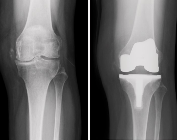 膝關節退化示意圖