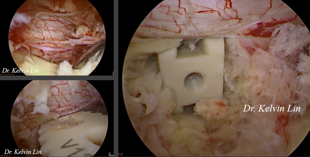 MIS TLIF 手術示意圖