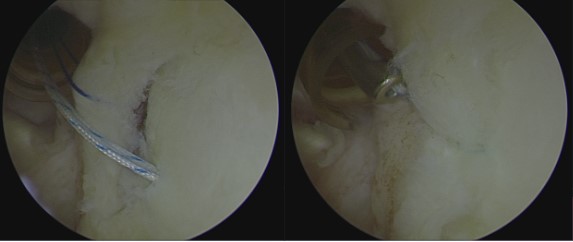 肩關節內視鏡示意圖