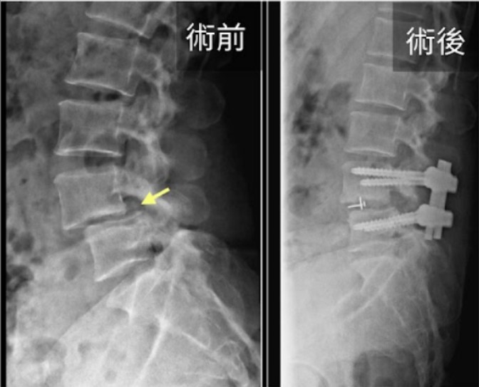 脊椎滑脫示意圖