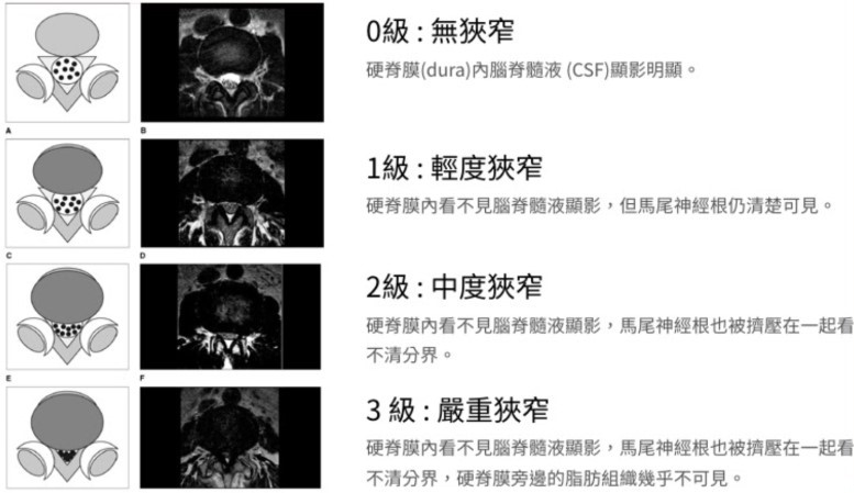 脊椎狹窄示意圖