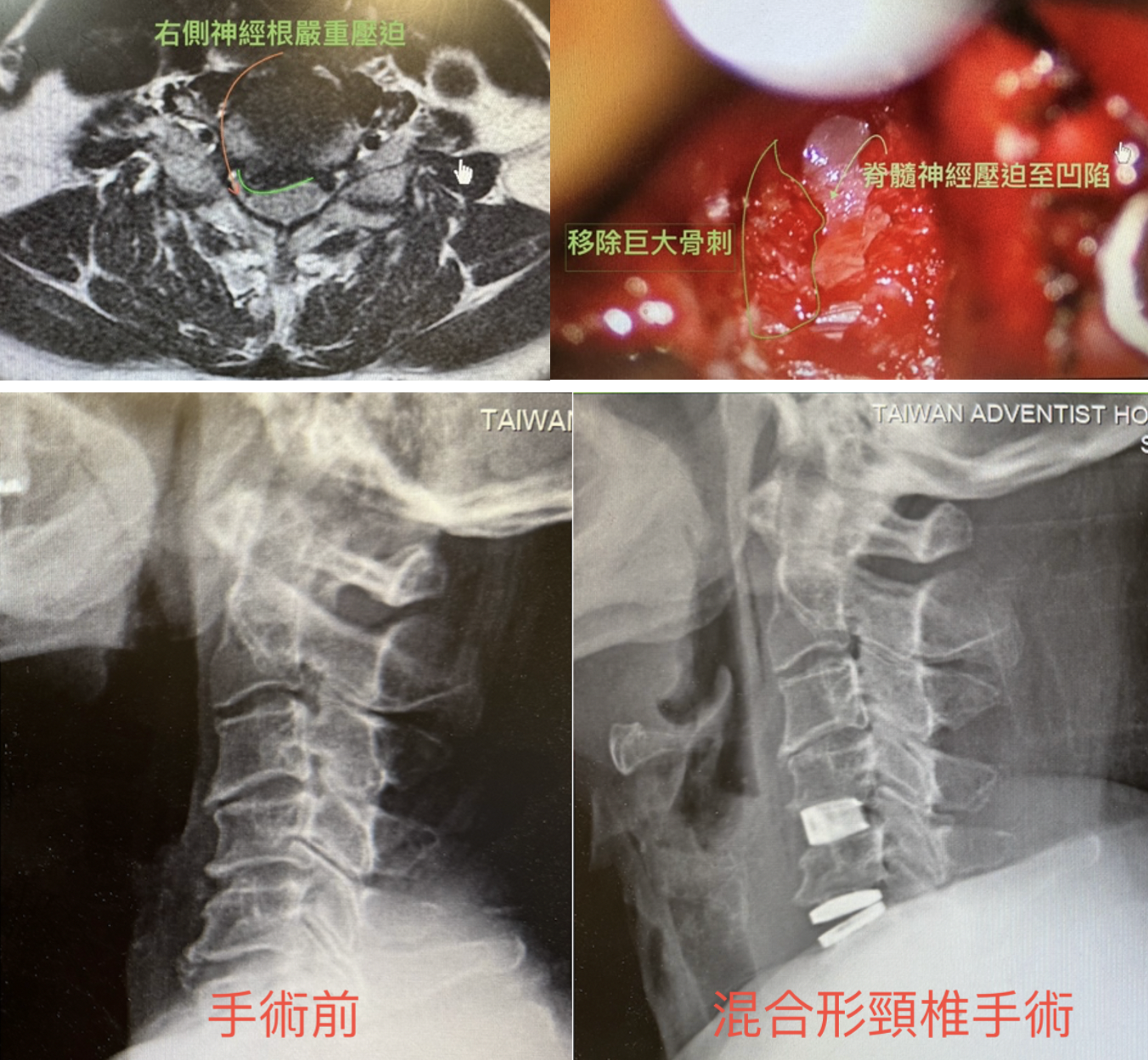 頸椎椎間盤突出，病人喊連呼吸都痛！65歲女性術後12小時順利出院，開心過年