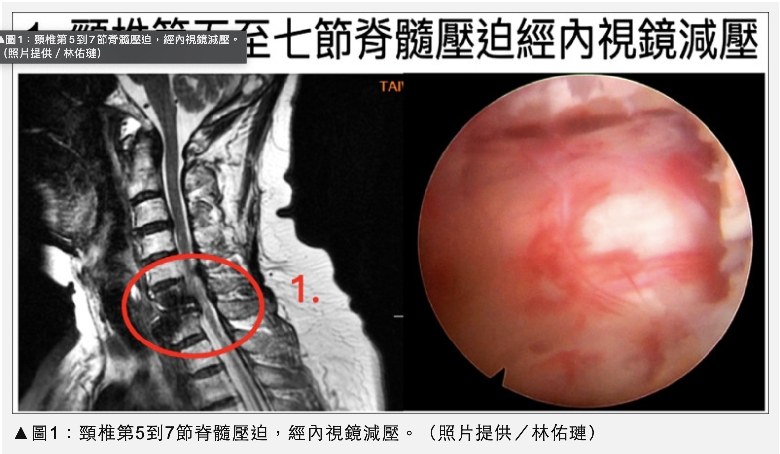 7旬婦「脊椎內視鏡手術」助擺脫輪椅 自由行走