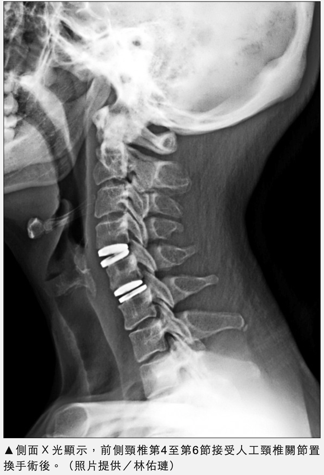 置換人工頸椎間盤 工程師24小時出院3天上班